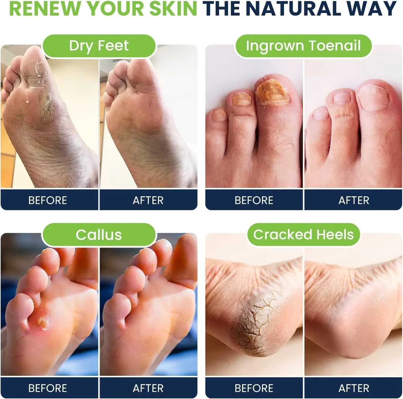 Tea Tree Oil Foot Soak with Epsom Salts- for Foot Pain, Soreness, Athletes Foot, Odors, Toe Nail Fungus, Fungal, Calluses Made in USA - 4 Pack